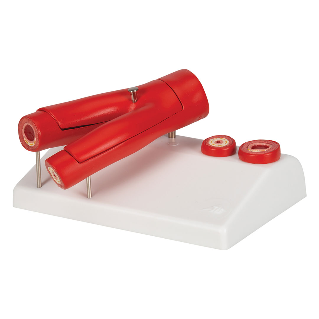 3B SCIENTIFIC Arteriosklerose Modell (G40) mit Querschnitt der Arterie, 2-teilig