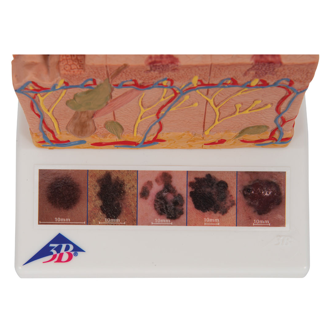 3B SCIENTIFIC Hautkrebs-Modell (J15)