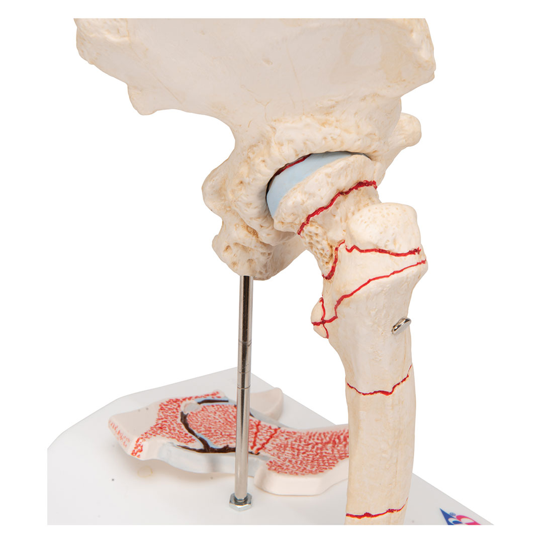 3B SCIENTIFIC Oberschenkelbruch und Hüftgelenkverschleiss (A88)