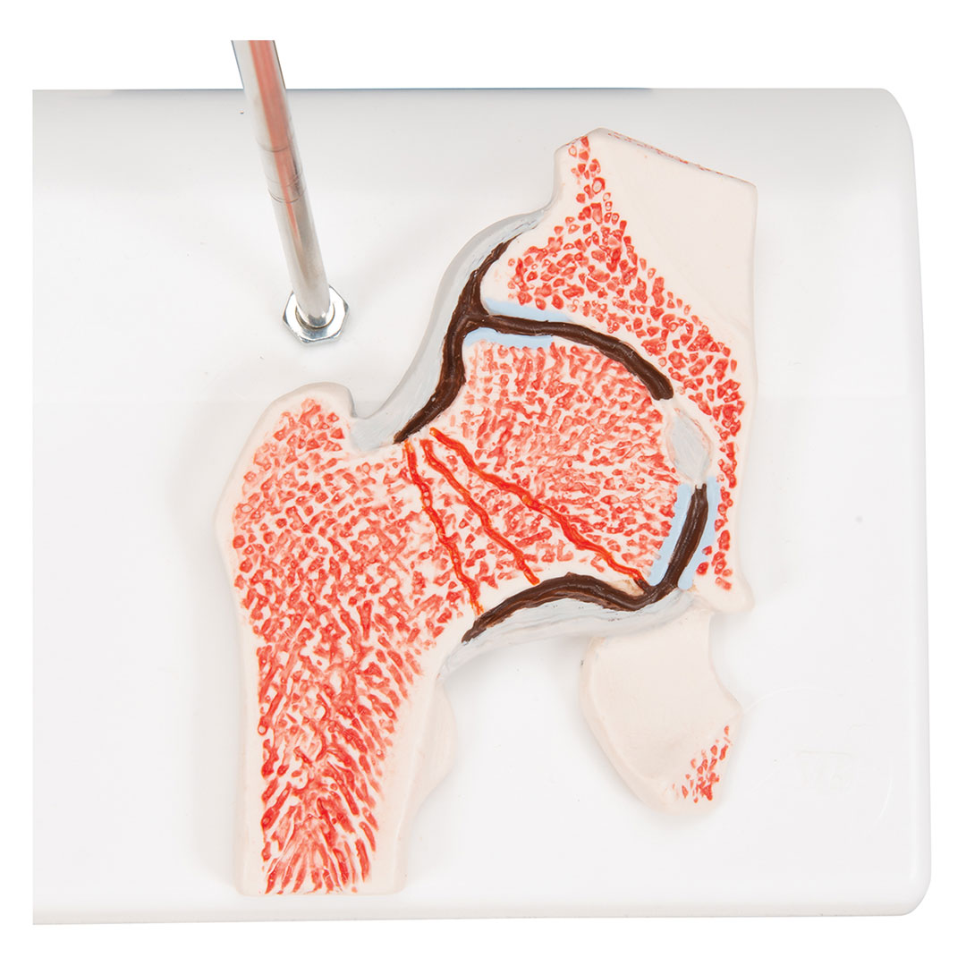 3B SCIENTIFIC Oberschenkelbruch und Hüftgelenkverschleiss (A88)