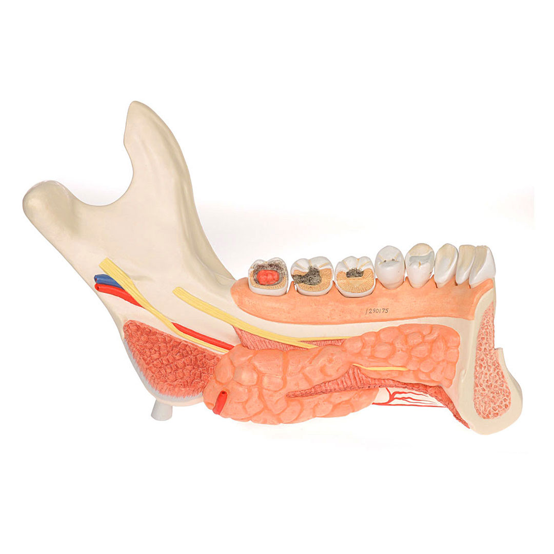 3B SCIENTIFIC Unterkieferhälfte m. 8 kariösen Zähnen, 19-teilig