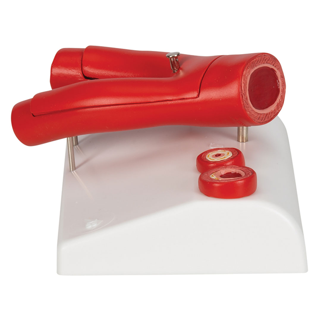 3B SCIENTIFIC Arteriosklerose Modell (G40) mit Querschnitt der Arterie, 2-teilig