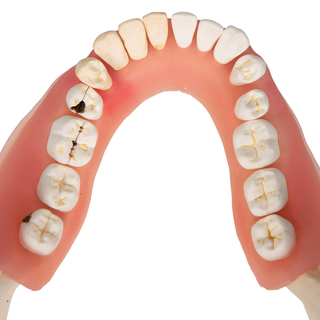 3B SCIENTIFIC Zahnerkrankung Unterkiefermodell 2-fach vergrössert (D26)