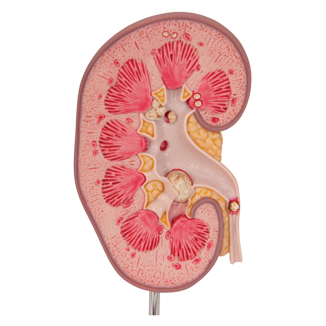 3B SCIENTIFIC Nierensteinmodell (K29)