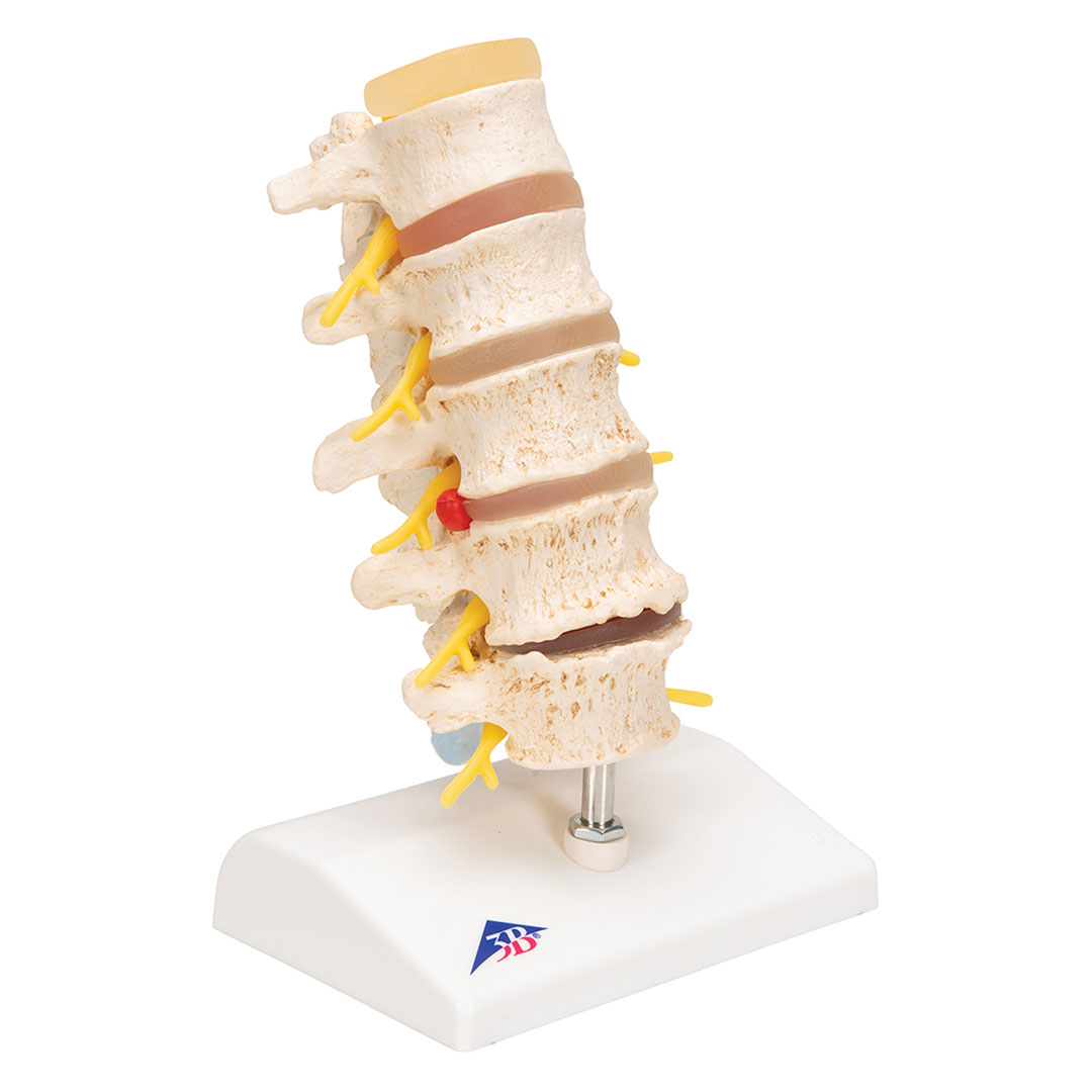 3B SCIENTIFIC Stadien des Bandscheibenvorfalls (A795)