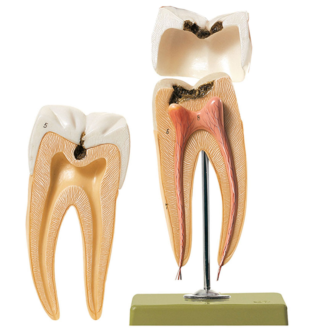 SOMSO® Backenzahn mit Karies