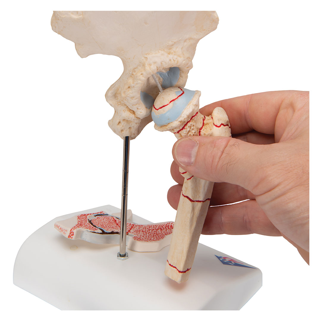 3B SCIENTIFIC Oberschenkelbruch und Hüftgelenkverschleiss (A88)