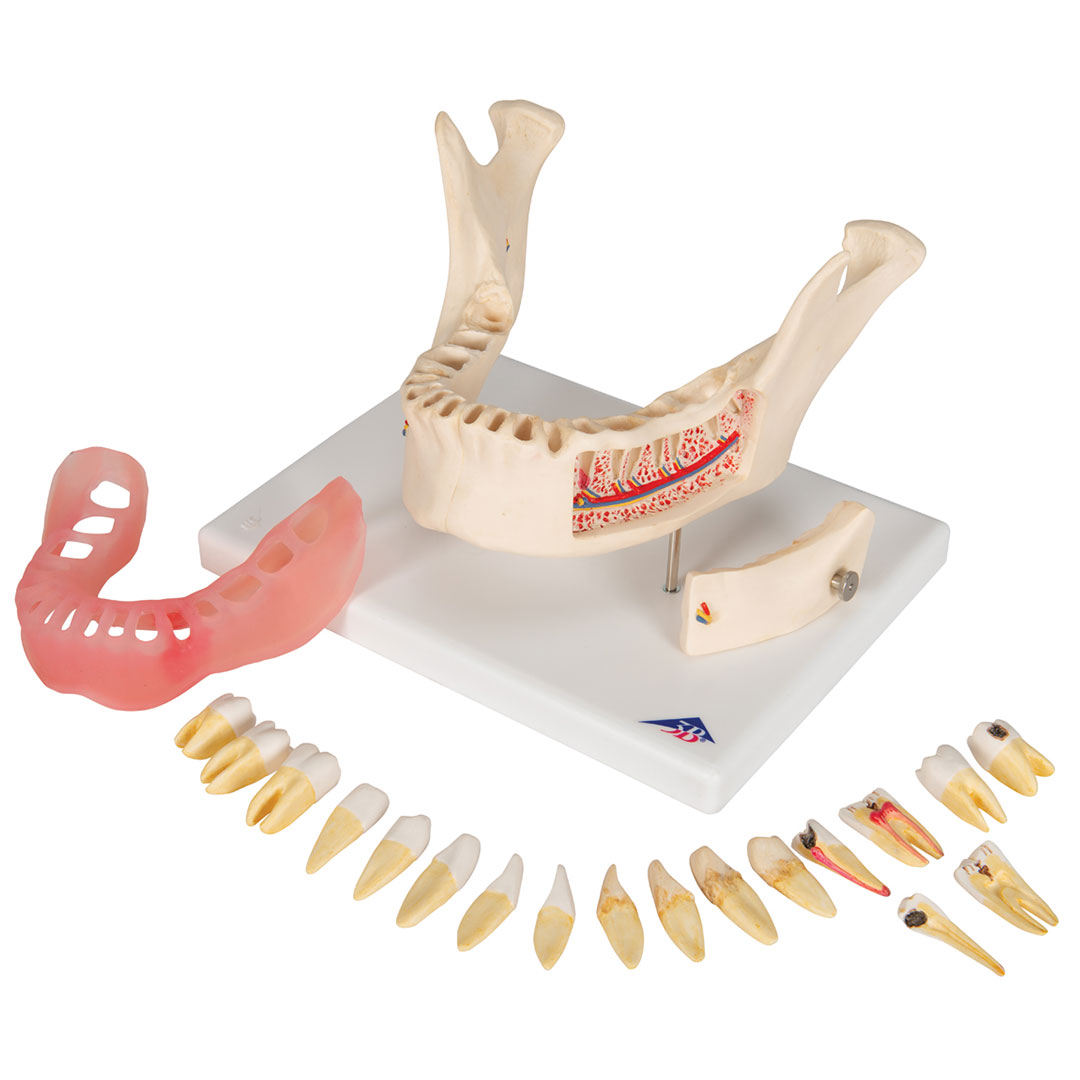 3B SCIENTIFIC Zahnerkrankung Unterkiefermodell 2-fach vergrössert (D26)