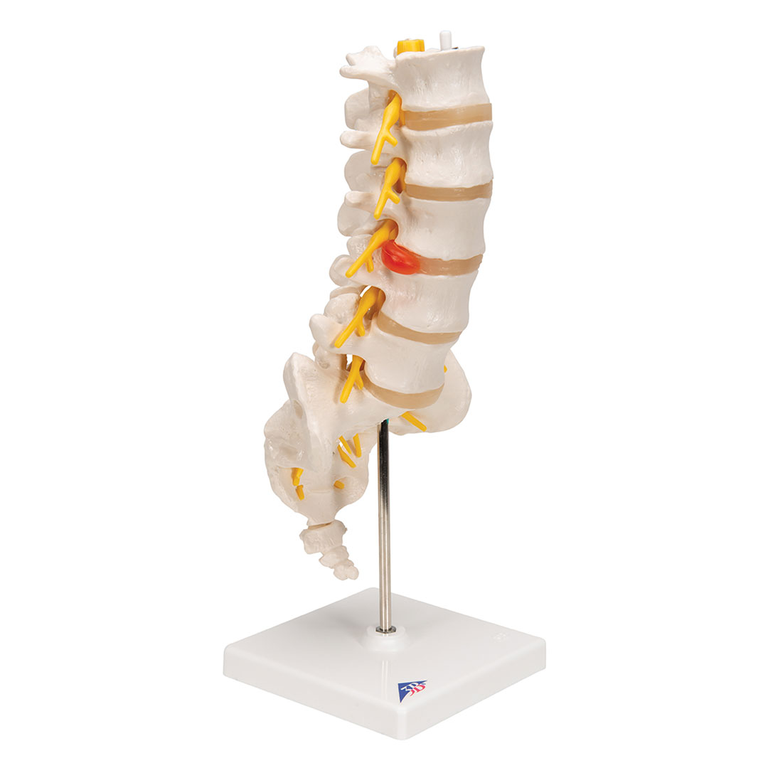 3B SCIENTIFIC Lendenwirbelsäule m. Bandscheibenvorfall (A76/5)